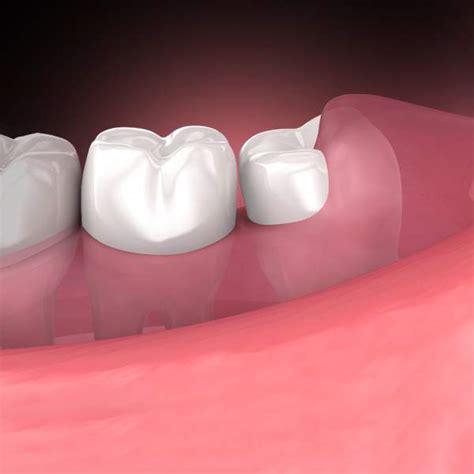 Oral Surgery Memphis Tn Oral Surgeon Wisdom Teeth Removal