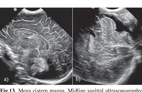 Figure 9 From Neonatal Head Ultrasound Systematic Approach To