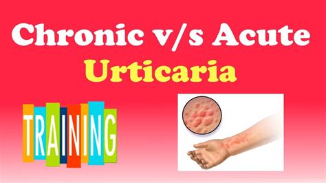 What Is Chronic Urticaria And Acute Urticaria Youtube