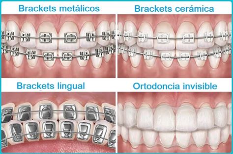 Qué Es La Ortodoncia Invisible Y Sus Tipos Grupogentevital