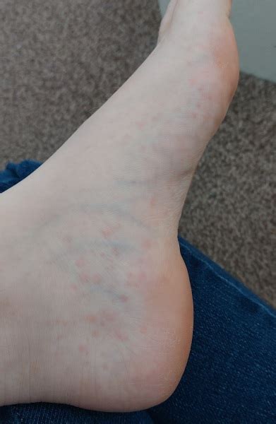 Scarlet Fever Rash On Feet Mumsnet
