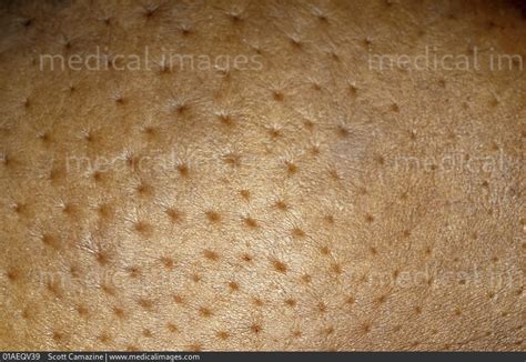 Stock Image Skin Over A Breast Cancer Diagnosed As Poorly