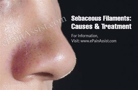 Sebaceous Filaments Causes And Treatment