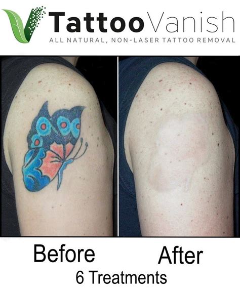 Tattoo Removal Cream Before And After Photos Christia Tubbs