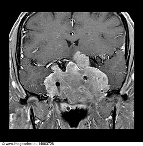 Invasive Pituitary Adenoma On Mri Invasive Pituitary Adenoma On Mri