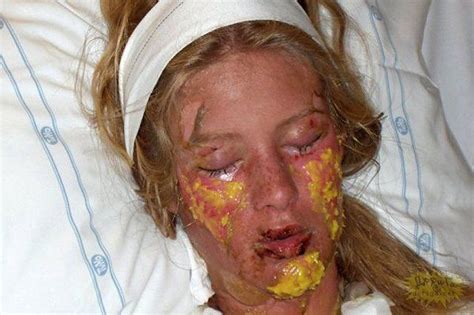 Documenting real life true crime cases as well as the images and videos that go with them. Toxic Epidermal Necrolysis