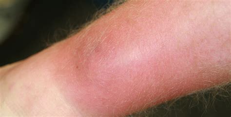 Cellulitis As Related To Bacterial Infections Pictures