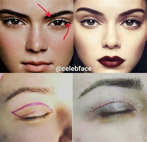 A healthy cat's eyes should be bright and clear. Kendall Jenner #blepharoplasty #eyelid #surgery | Kendall ...