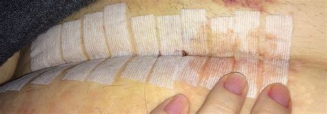 Change your sanitary pads at least every four hours as this reduces the likelihood of getting an infection in the area. TMI ALERT - C Section Incision Drainage & Spreading ...