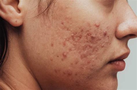 Acne Face Map The Cause Of These Breakouts Cleveland Clinic