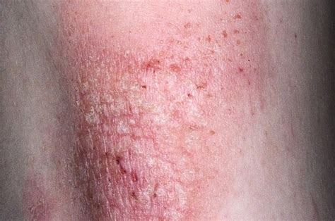 745 Best All About Eczema Images On Pinterest My Blog