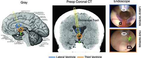 Lateral And Third Ventricle Orientation In Human Endoscopic Third