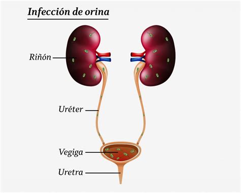 Infección urinaria Dra Teresa Aznar