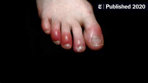 What Is ‘covid Toe Maybe A Strange Sign Of Coronavirus Infection