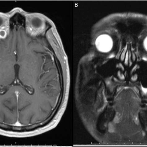 Case 1 Mri Imaging A T1 Post Contrast Axial Magnetic Resonance