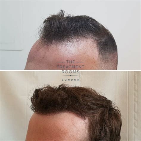 Fue Hair Transplant Before And After Treatment Rooms London