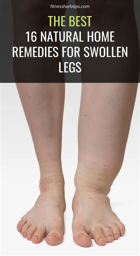The Best 16 Natural Home Remedies For Swollen Legs Natural Home