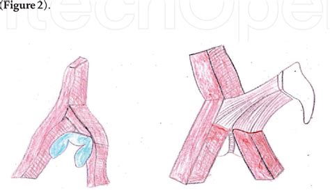 Figure 1 From Surgical Anatomy Of Acetabulum And Biomechanics