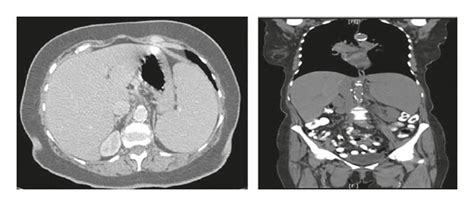 Ct Scan Showing A 15 Cm Splenomegaly After Cll Diagnosis In 2006 B