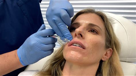 Film Starlette Cory Chase Gets Plump Lips With Restylane Kysse Oceandriveplasticsurgery Com