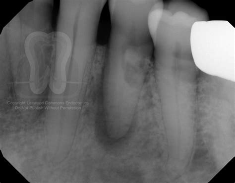 Resorption Repair Tooth 21 Leawood Commons Endodontics