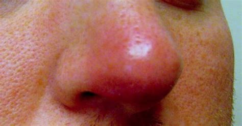 Furunculosis Of The Nasal Vestibule Causes Diagnosis Complications