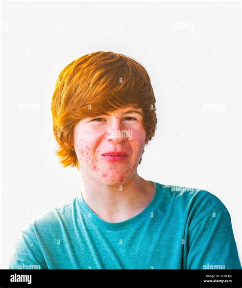 Smart Happy Boy In Puberty With Acne Stock Photo Alamy