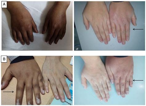 Changes In The Skin Pigmentation Of The Two Patients Before And After