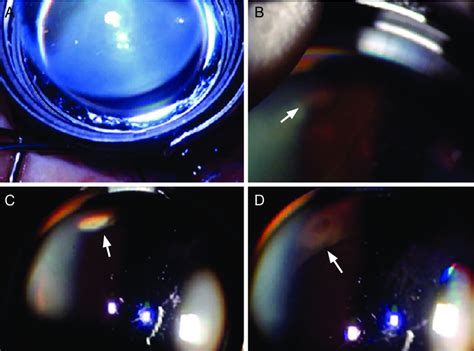 Surgical Photographs Of Scleral Buckling Surgery Performed Using