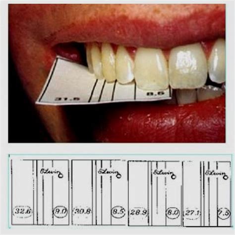 Dental Grid Paper “best Buy” Golden Mean Gauge