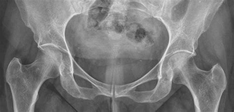 Cureus Transient Osteoporosis Of The Hip A Radiologists Perspective