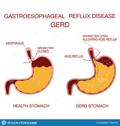 Heartburn And Gastroesophageal Reflux Disease Gerdconcept Health Stock