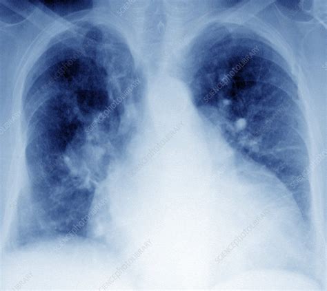 Enlarged Heart X Ray Stock Image C0212949 Science Photo Library