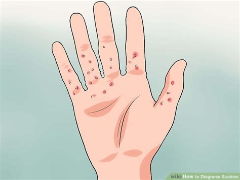 How To Diagnose Scabies Wiki Skin Inflammation And Rashes English