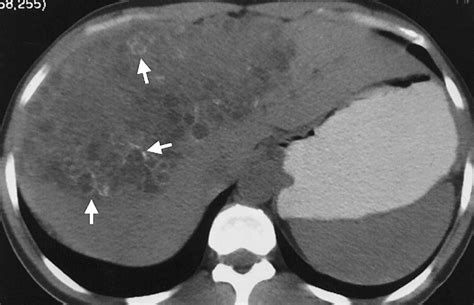 Echinococcal Cyst Radiographics
