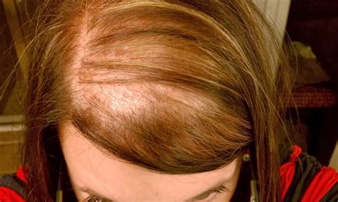 Female Hair Loss Is On The Rise