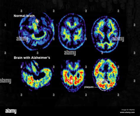 Normal And Alzheimer Brains Pet Scans Stock Photo Alamy