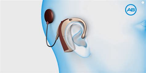 Advanced Bionics Cochlear Implant Accessories Connect Hearing