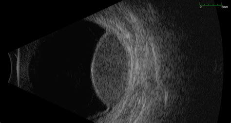 Large Dome Shaped Peripheral Choroidal Melanoma B Scan Retina