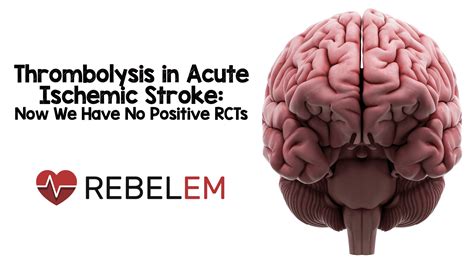 Thrombolysis In Acute Ischemic Stroke Now We Have No Positive Rcts