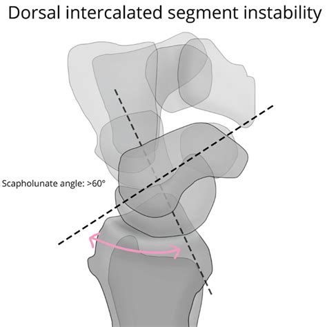 Filenormal Wrist Alignment Dorsal And Volar Intercalated Segmental