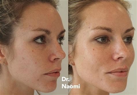 Dermal Fillers For Girl In Her 20s Before And After Best Clinic Sydney For Dermal Fillers