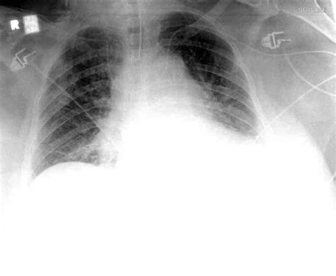 Figure Chest Radiograph Malpositioned Central Line Contributed By Scott Dulebohn Md