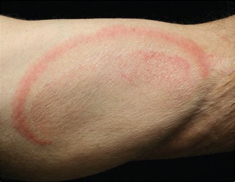 Erythematous Annular Scaling Patches On The Skin Aafp