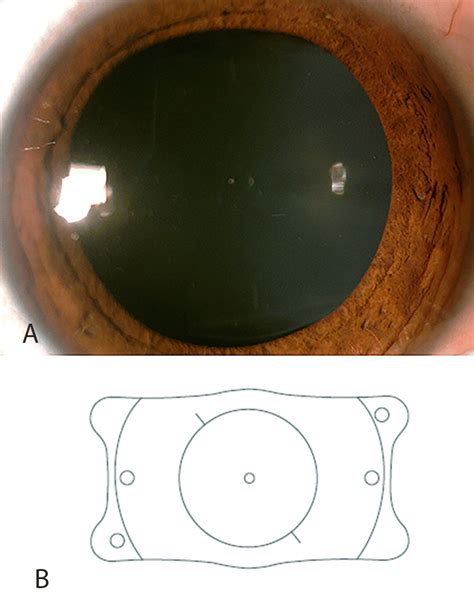 A Eyecryl Toric Phakic Iol Implanted In The Posterior Chamber B Download Scientific Diagram