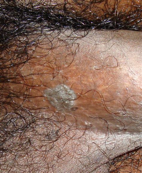 A condyloma acuminatum tünetei, kezelése és megelőzése