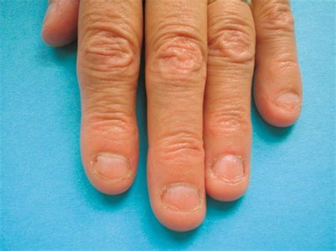 Under The Microscope Onychophagy Nail Disorders Nail Care Routine