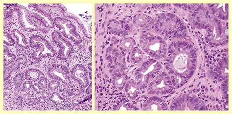 Gastric Dysplasia Update And Practical Approach Diagnostic