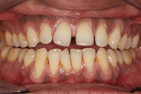 Invisalign Before And After 425 Dental