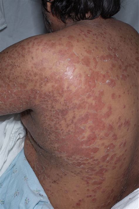 Disseminated Bullous Impetigo In An Adult With Atopic Dermatitis Flare